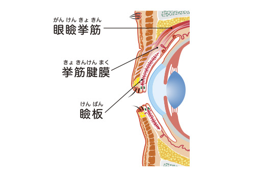 眼瞼下垂の手術